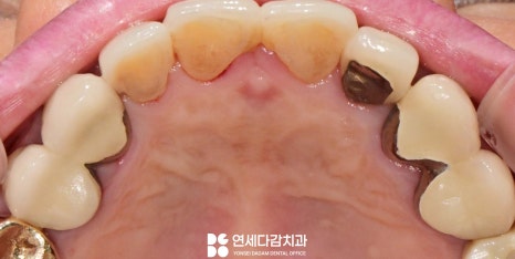 앞니 레진 후 생긴 변색 문제와 삐뚤어진 치아 개롱역 치과 최소삭제 라미네이트 적용할 수 있는 이유 관련 이미지 8