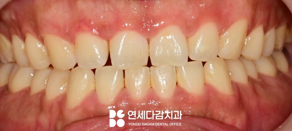 연세다감치과 심미 치료 무삭제 라미네이트 통해 자신감 있는 미소를 되찾는 여정 관련 이미지 1