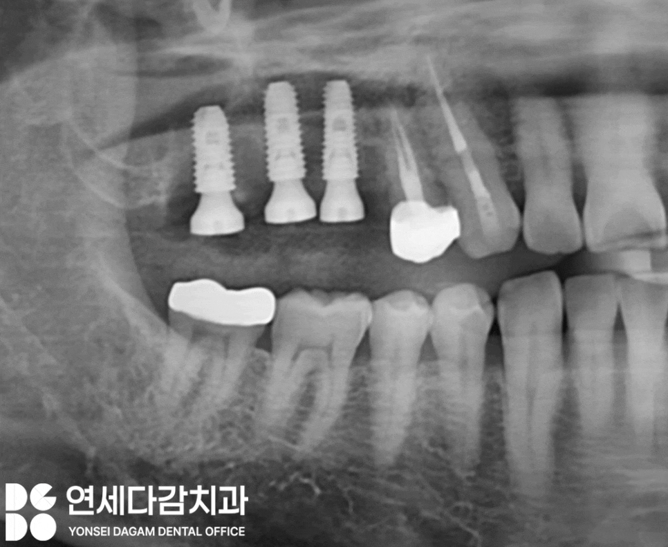 축농증 수술 후에도 임플란트 수술 가능할까? 특별한 송파구 치과 케이스의 해결책 관련 이미지 5