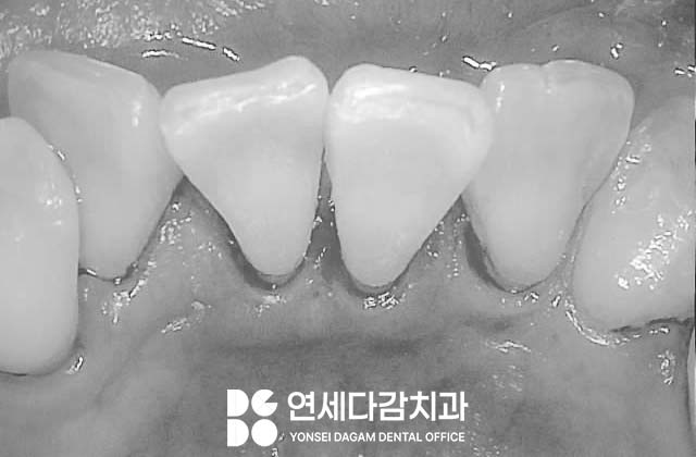 이시림 원인 치경부 마모증 치료할 때 쓰이는 문정역 치과 레진과 G.I 재료의 특성 관련 이미지 3