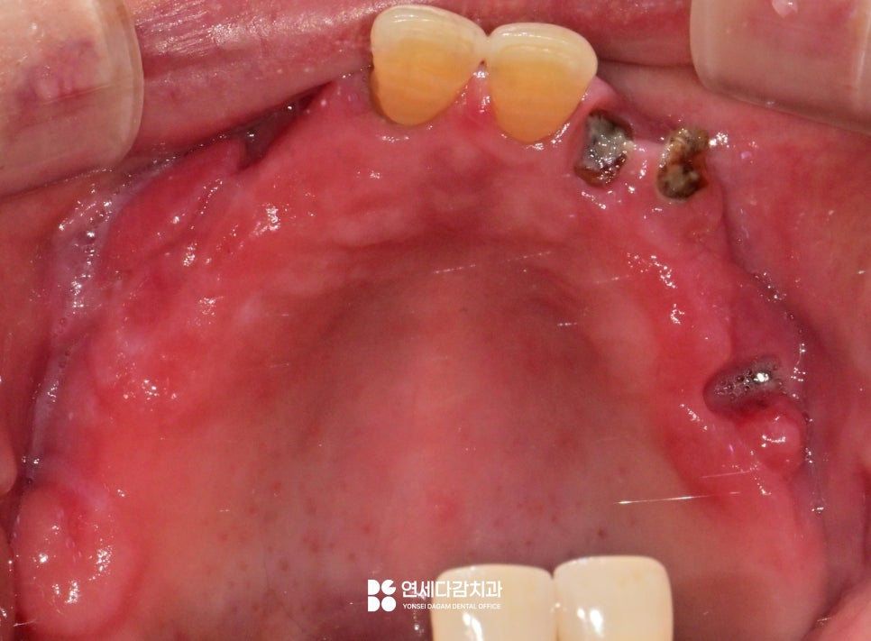 개롱역 치과 치주 질환으로 인한 심한 잇몸뼈 손실 - 네비게이션 방식 임플란트로 진행된 안전한 치료 관련 이미지 3