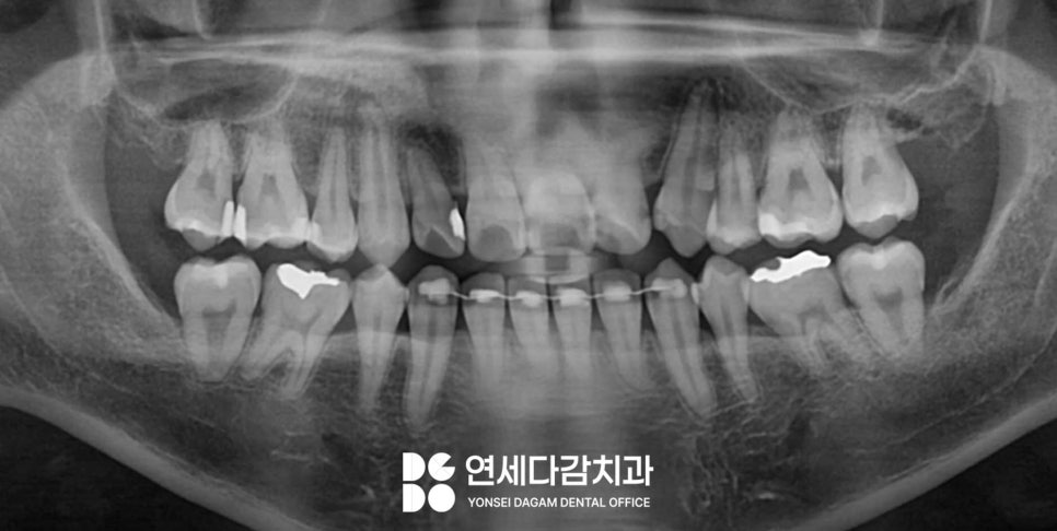 매복 사랑니 발치 시 관련 이미지 7