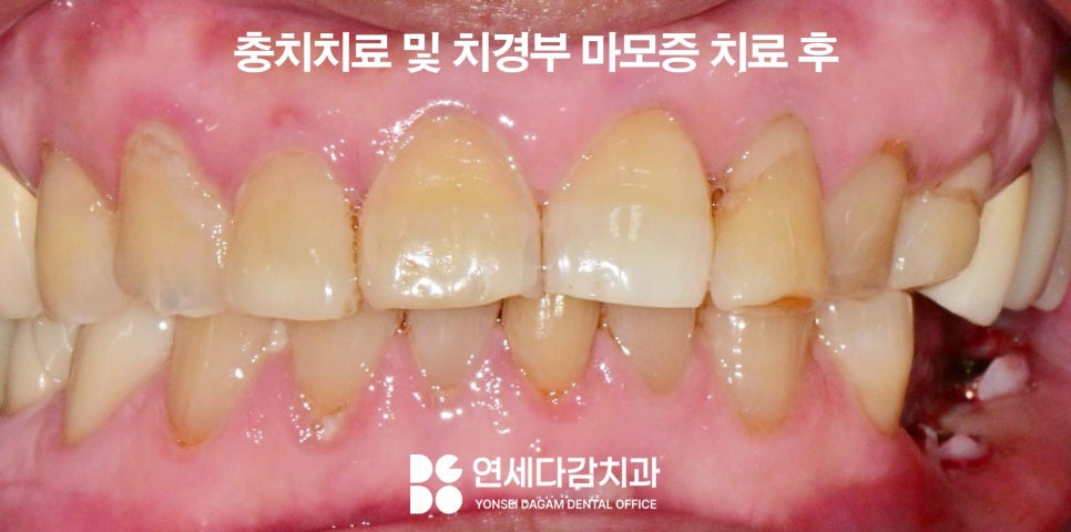 하얀 치아가 가져오는 인상의 변화 오금동 치과 교정 없이 최소삭제 라미네이트 심미치료 통해 치열 및 누렁니 개선 관련 이미지 3
