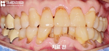 치아 이시림 왜 더 심해질까 개롱역 치과 치경부 마모증 원인과 레진 충전 및 글래스아이오노머(GI) 치료 특징 비교 관련 이미지 4