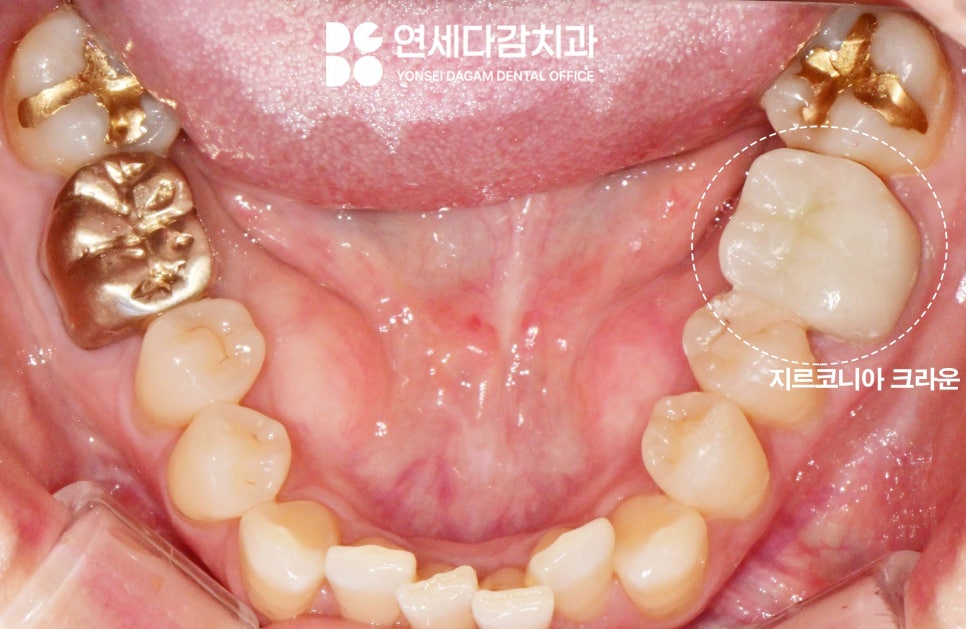 거여역 치과 미다졸람 수면마취 의식하진정법 임플란트 수술 말고 스케일링 크라운 치료 과정에서도 쓰이는 이유 관련 이미지 5
