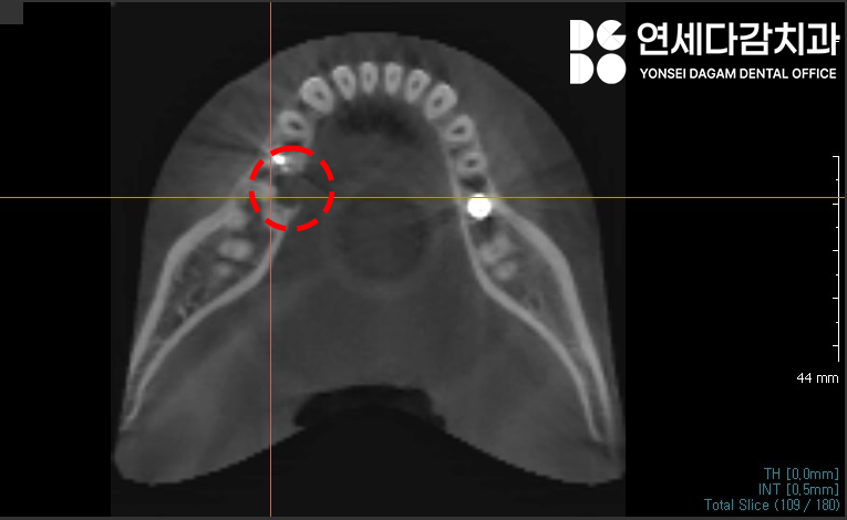 매복과잉치 를 발치할 때 CT 촬영이 필요한 이유? 연세다감치과 의학 정보 전달 글 관련 이미지 8