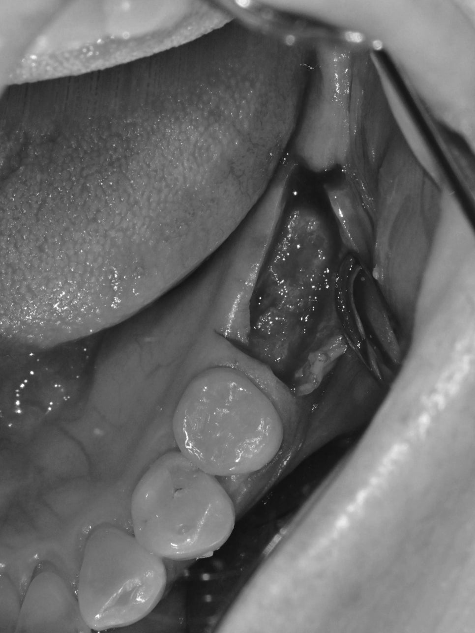 Munjeong-dong Dental Clinic, Bone Graft Implant Process&middot; What If You’ve Lost a Molar? image 8