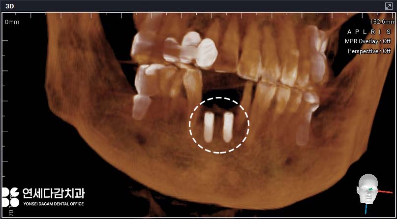유독 까다로운 수술 부위가 있다? 오금역 치과 브릿지에서 임플란트 전환 과정 관련 이미지 4