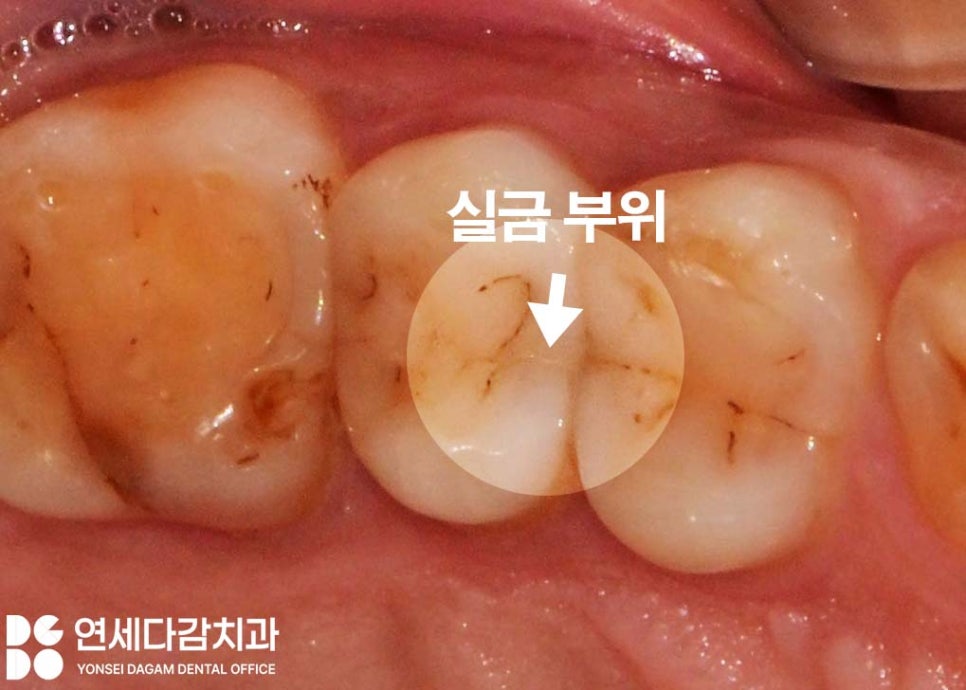 두통까지 아픈 어금니 치아 통증 송파역 치과 금간치아 신경치료 후 크라운 꼭 씌워야 되는 이유 관련 이미지 2