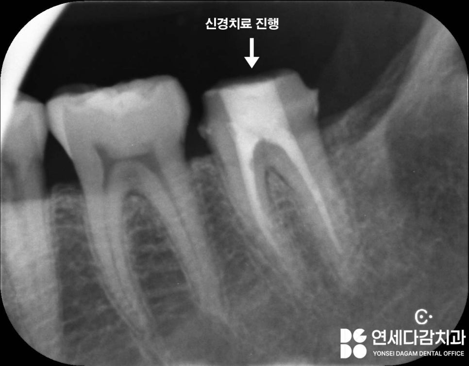 어금니 깨짐, 치아에 금 갔을 때 찌릿한 통증 가락시장역 치과 신경치료 후 크라운 꼭 씌워야 되는 이유와 예방법 관련 이미지 5