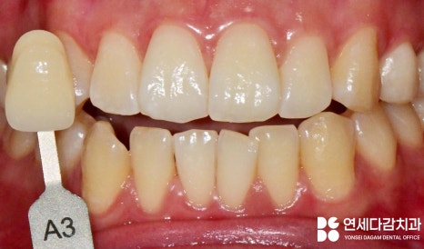 거여동 치과 전문가 치아 미백 원리와 올바른 관리 방법 알아봅시다. 관련 이미지 4
