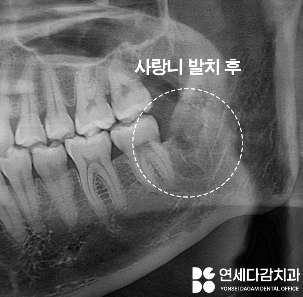 사랑니 부위 잇몸이 붓고 음식물이 자주 껴요 가락동 치과 매복사랑니 발치 후 지혈제 꼭 써야 좋을까? 관련 이미지 7
