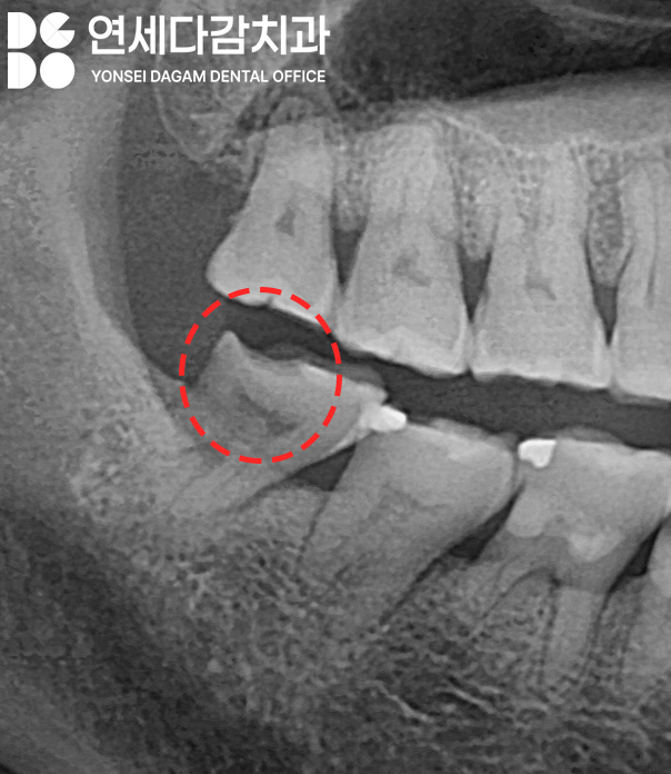 심한 이갈이 원인으로 생기는 치아 마모 및 파절 문제 문정역 치과 교모증 크라운 치료 필요한 이유 관련 이미지 6
