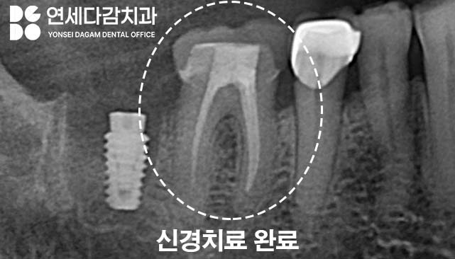 어금니 찌릿한 통증 치아에 금갔을때 신경치료 크라운 가락시장역 치과 충치 깊을 때 당일 발치 임플란트 및 부러진 보철 임플란트재식립 관련 이미지 3