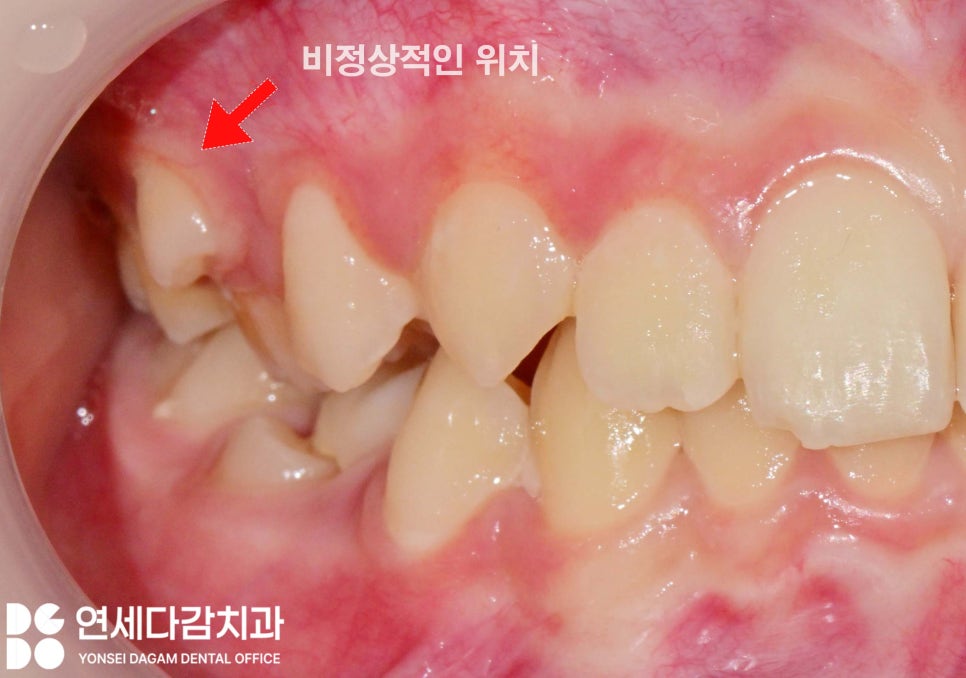 우리 아이 치아 성장 과정 가락시장역 치과 에서 알려주는 소아 유치 빠지는 순서 영구치 나는 시기 관련 이미지 5