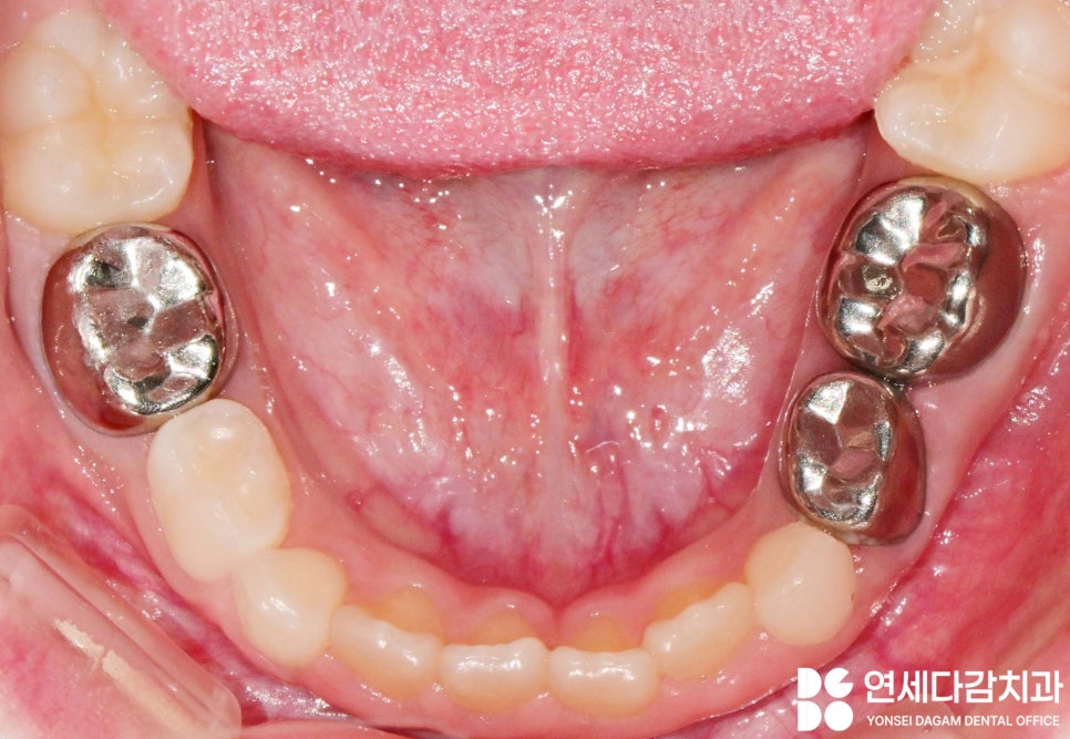 ss크라운 깨졌을 때 다시 제작 가능할까? 송파역 치과 소아 치료 진정요법 없이도 가능했던 이유 관련 이미지 4
