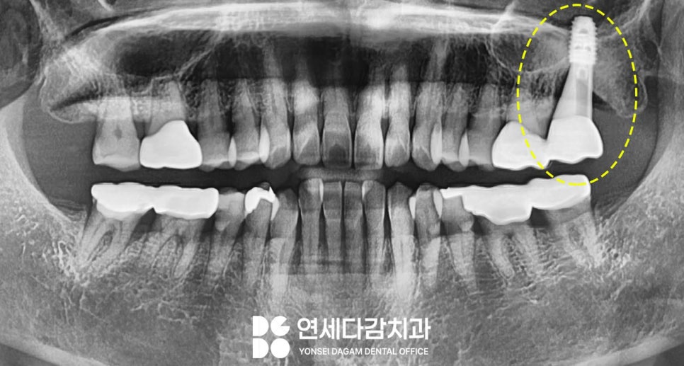 심한 염증으로 특이한 곳에 위치한 매복 사랑니 송파역 치과 에서 임플란트 수술과 함께 안전한 발치 했습니다. (feat. 상악동 천공 폐쇄술 ) 관련 이미지 7