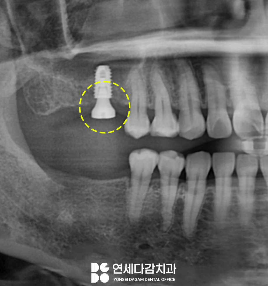 발치 후 생기는 잇몸뼈의 변화로 임플란트 과정이 복잡해질 수 있습니다 경찰병원역 치과 에서 알아보는 상악동 거상술. 관련 이미지 3