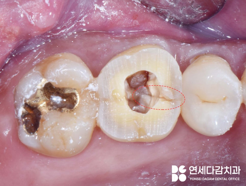 어금니 깨짐, 치아에 금 갔을 때 찌릿한 통증 가락시장역 치과 신경치료 후 크라운 꼭 씌워야 되는 이유와 예방법 관련 이미지 7