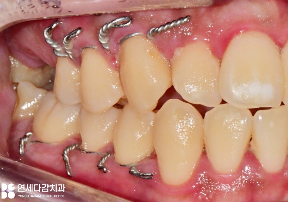 문정역 치과 에서 알아보는 턱뼈 골절 됐을 때 악간고정술 치료 같이 진행하는 이유 관련 이미지 5