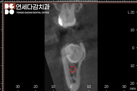 복잡한 매복 사랑니 발치 오금동 치과 에서 CT 촬영을 통한 분석 과정 관련 이미지 6