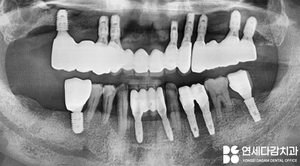 불편한 틀니 임플란트로 바꿔 치료할 수 있을지 가락시장역 치과 에서 살펴봅시다. 관련 이미지 8