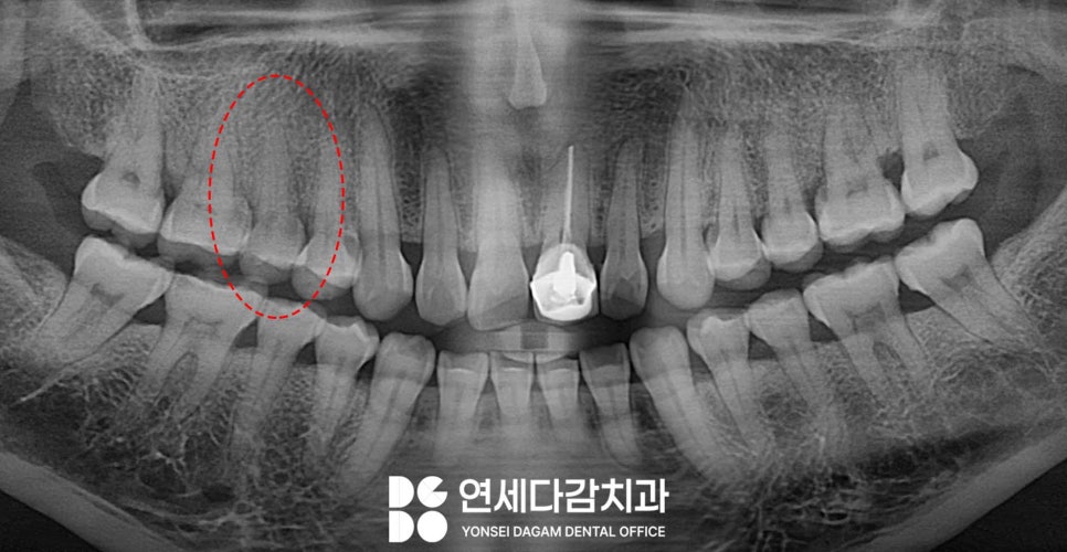 두통까지 아픈 어금니 치아 통증 송파역 치과 금간치아 신경치료 후 크라운 꼭 씌워야 되는 이유 관련 이미지 1