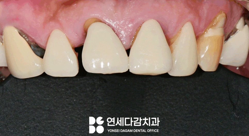치주염 원인으로 치아 흔들림 오금동 치과 크라운 치료 통해 뻐드러진 앞니 돌출입 해소 과정에서 잇몸치료 필요한 이유 관련 이미지 1