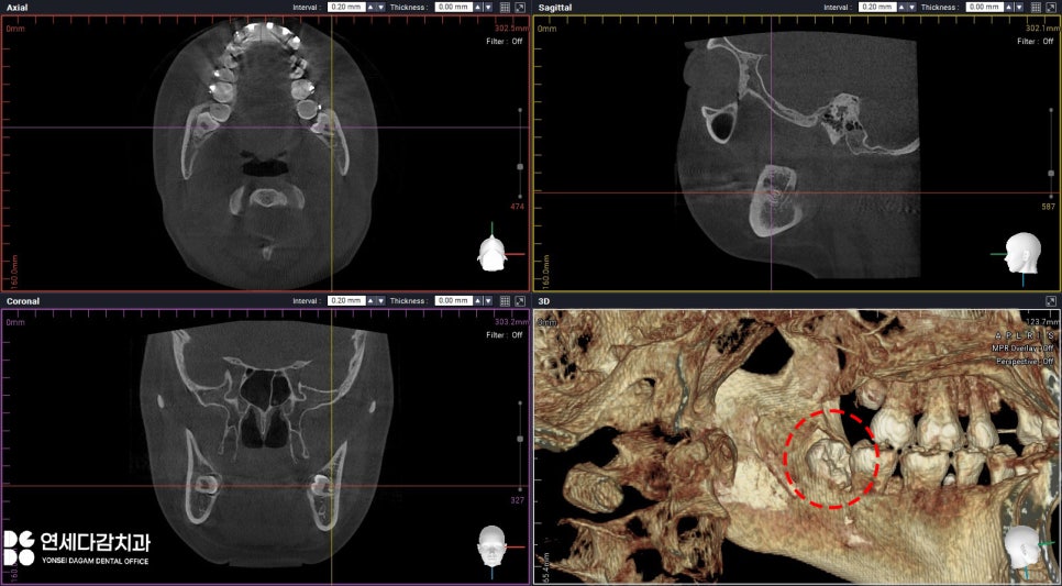 교정 중 사랑니 발치 진단 오금동 치과 에서 설측 수평 매복 발치 과정 알려드리겠습니다. 관련 이미지 2