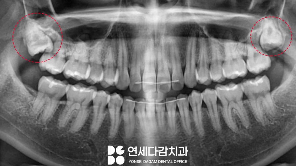 기울어진 매복 사랑니 발치 더 주의깊게 봐야 되는 이유 개롱역 치과 에서 살펴봅시다. 관련 이미지 5