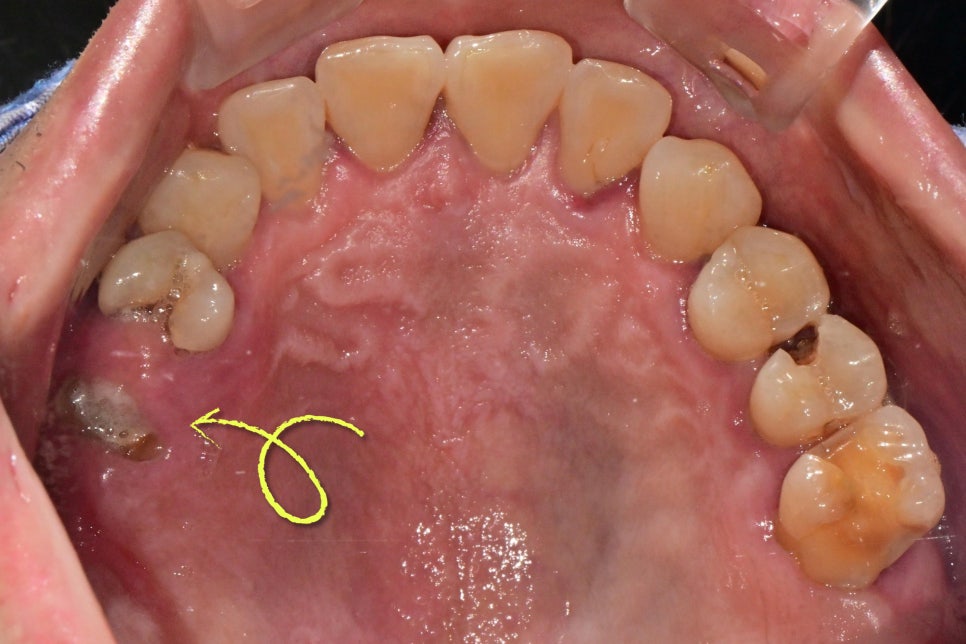 Why a Sinus Lift May Be Needed When There Is Insufficient Bone for Implants in Munjeong-dong image 3