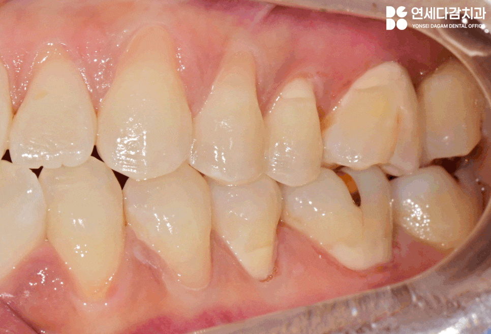 이시림 원인 치경부 마모증 치료할 때 쓰이는 문정역 치과 레진과 G.I 재료의 특성 관련 이미지 6