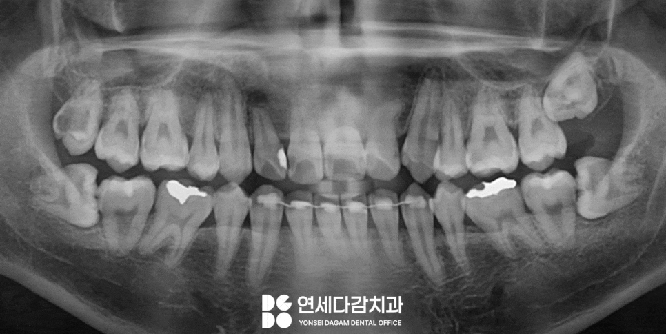 매복 사랑니 발치 시 관련 이미지 1