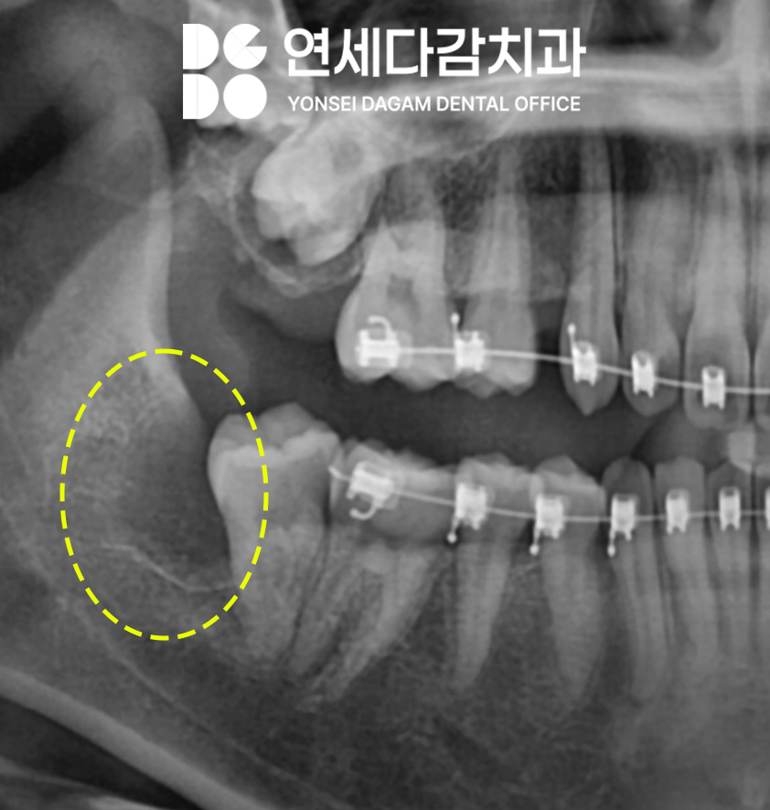 교정 중 사랑니 발치 진단 오금동 치과 에서 설측 수평 매복 발치 과정 알려드리겠습니다. 관련 이미지 3