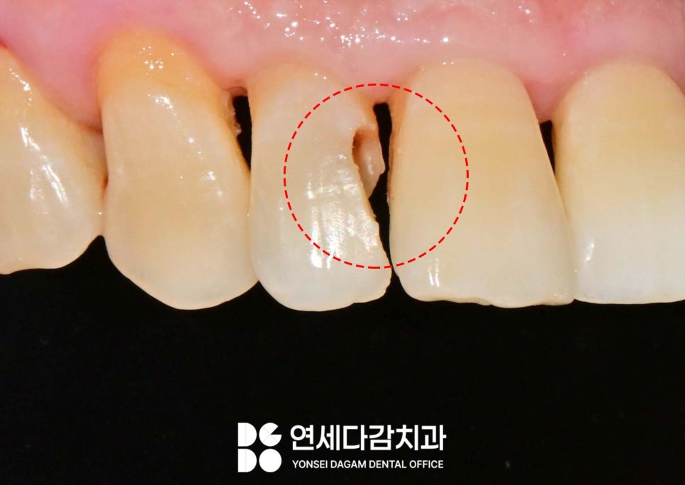 앞니 충치 꼭 크라운 해야 좋을까 송파역 치과 치아 사이 인접면 우식 레진 치료 만으로 충분한 경우 관련 이미지 4