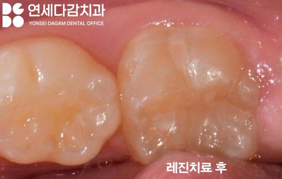 오금동 치과 충치 레진 치료 보험 혜택받을 수 있을까 우리 아이 구강 건강을 위한 치아 우식 예방법 관련 이미지 6