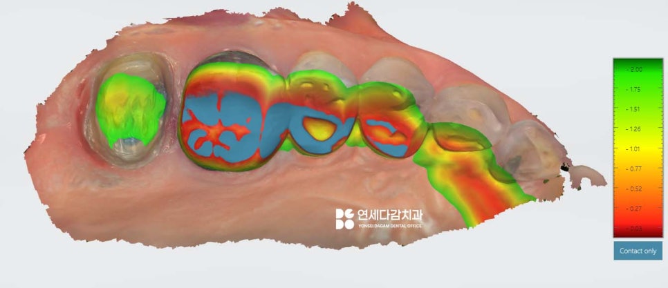 크라운 빠졌을 때 다시 붙일 수 있을까 문정동 치과 구강 스캐너 통한 보철 제작 관련 이미지 3