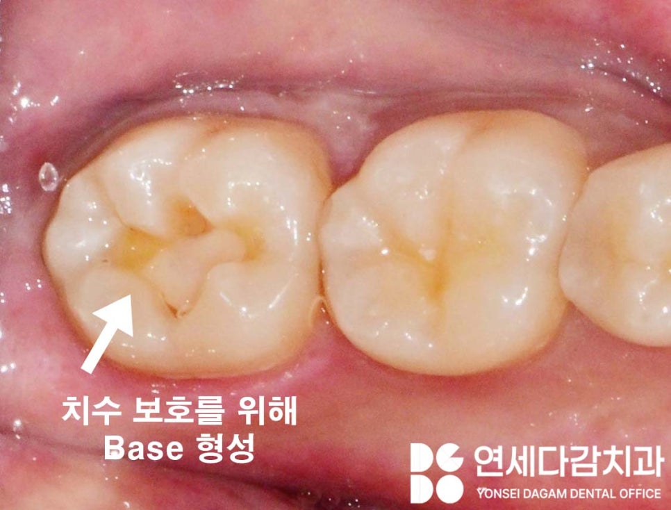 충치 범위에 따른 치료 방법 가락동 치과 레진 또는 인레이 언제 적용할 수 있을까? 관련 이미지 5