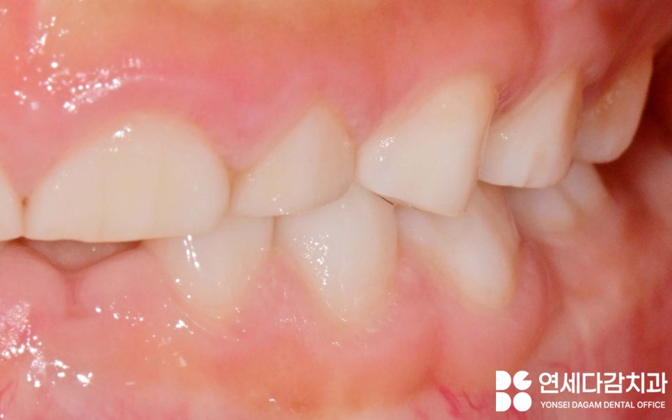 치아 마모 원인 소아 이갈이 치료 꼭 해야 될까 오금역 치과 에서 알아보는 원인과 관찰해야 될 징후들 관련 이미지 3