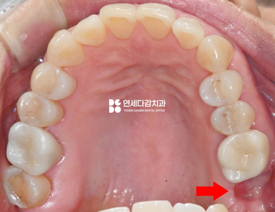 심한 염증으로 특이한 곳에 위치한 매복 사랑니 송파역 치과 에서 임플란트 수술과 함께 안전한 발치 했습니다. (feat. 상악동 천공 폐쇄술 ) 관련 이미지 4