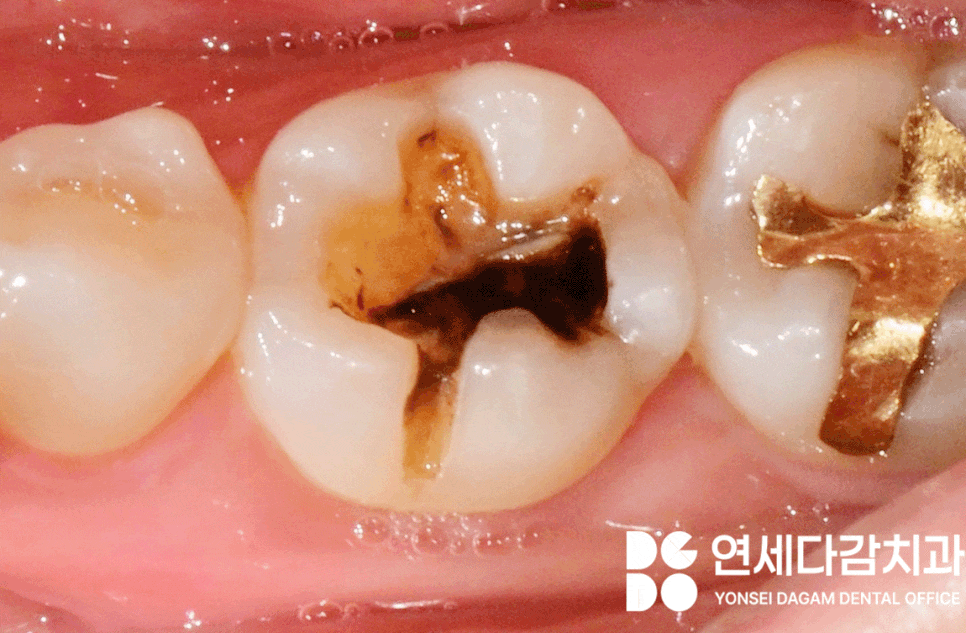 오금역 치과 어금니 골드 인레이 떨어짐 재치료 꼭 필요할까 탈락한 원인 파악이 중요한 이유와 보철 종류 특징 관련 이미지 1