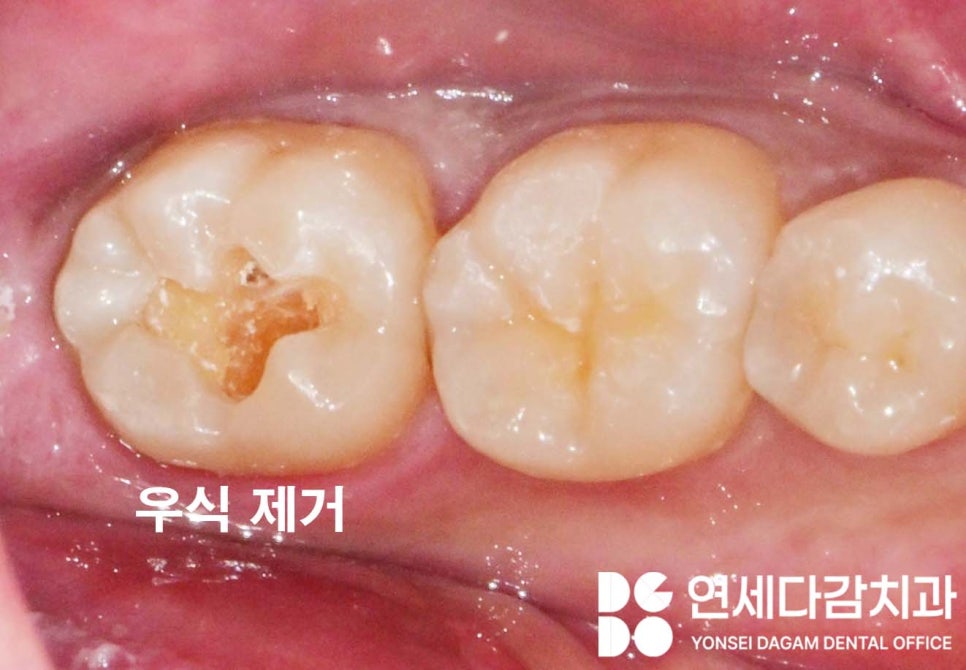 충치 범위에 따른 치료 방법 가락동 치과 레진 또는 인레이 언제 적용할 수 있을까? 관련 이미지 4