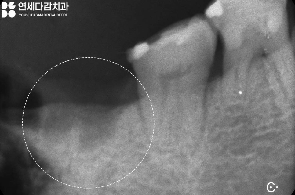 심한 이갈이 원인으로 생기는 치아 마모 및 파절 문제 문정역 치과 교모증 크라운 치료 필요한 이유 관련 이미지 7