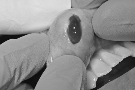 Geoyeo Station Dental Clinic, Mucous Cyst Removal&middot;What If a Lump-Like Bump Protrudes Inside Your Mouth? image 2