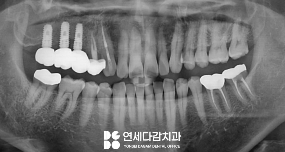 축농증 수술 후에도 임플란트 수술 가능할까? 특별한 송파구 치과 케이스의 해결책 관련 이미지 6