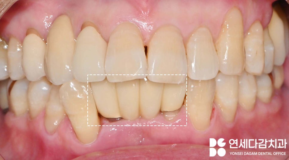 유독 까다로운 수술 부위가 있다? 오금역 치과 브릿지에서 임플란트 전환 과정 관련 이미지 2