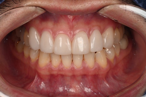 Ogeum-dong Dentist: Want to Improve Front-Tooth Discoloration and Black Triangles at Once with Veneers? <Must-Read> image 5
