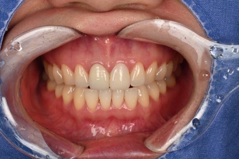 Songpa-dong Dentist: It Wasn’t Just the Front Crown That Was Replaced! A retreatment case that also considered the gum line image 6