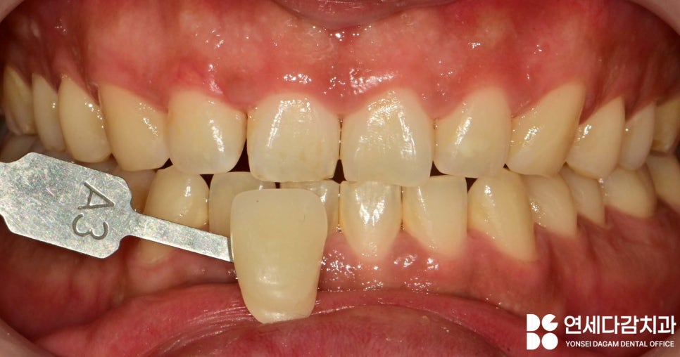 연세다감치과 심미 치료 무삭제 라미네이트 통해 자신감 있는 미소를 되찾는 여정 관련 이미지 2
