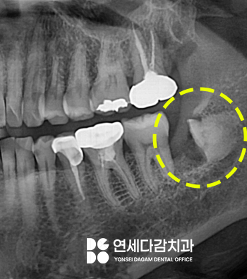 신경과 가까운 매복 사랑니 절반만 잘라서 남긴다고요? 오금역 치과 에서 알려드리는 치관절제술 통한 안전한 발치! 관련 이미지 6